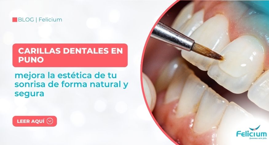 Carillas dentales en Puno