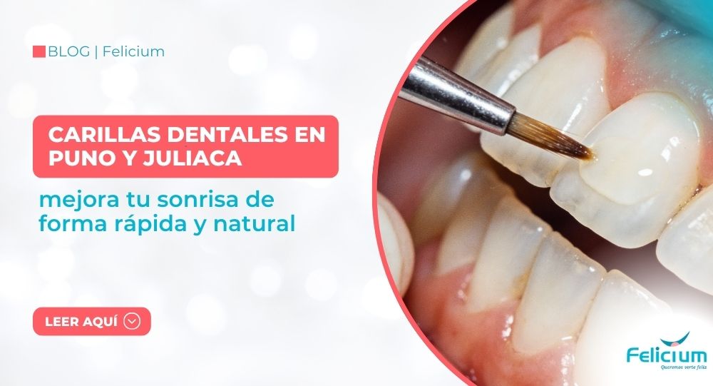 Carillas dentales en Puno y Juliaca